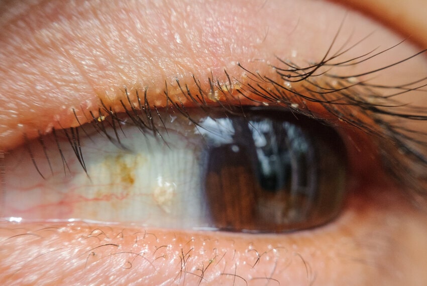 Close-up side view of a brown eye with visible eyelashes, yellowish crust on the upper lash line, and a small pale yellow spot on the sclera near the inner corner. Blepharitis Ace QBank clinical edge.
