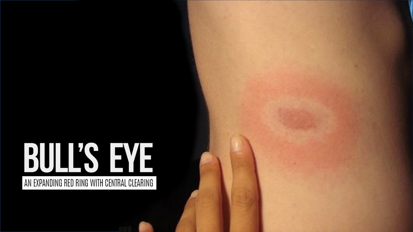 A hand points to a red, circular rash with a pale center on a person’s skin. A classic tick bite finding often seen in Ontario. Text reads, “BULL’S EYE. An expanding red ring with central clearing.”