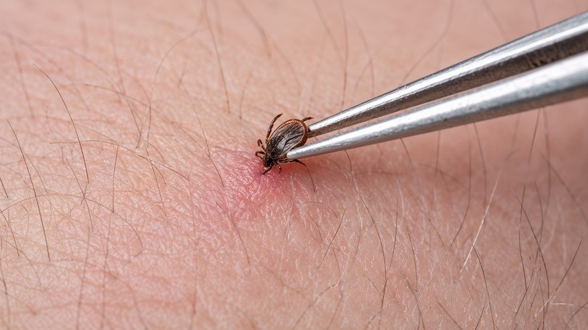 Close-up of tweezers removing a tick from irritated human skin, highlighting the importance of proper tick removal to help prevent Lyme Disease in Ontario.